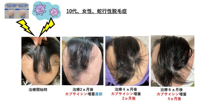 円形脱毛症　病院